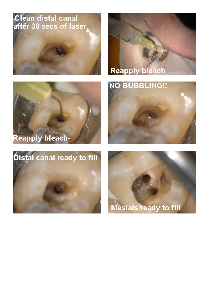 Endo on molar edited pg 3.jpg